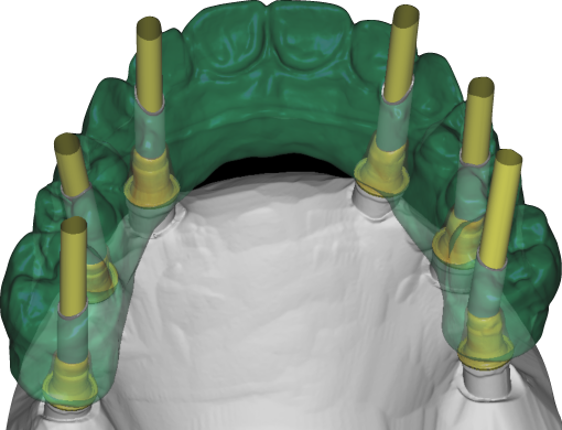 pont complet sur implant en CAD