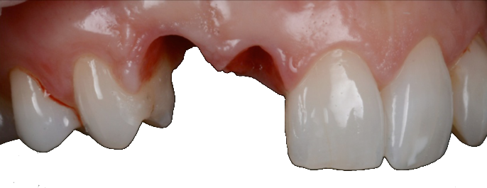 Préparation du dentiste en bouche des dents 22 et 23