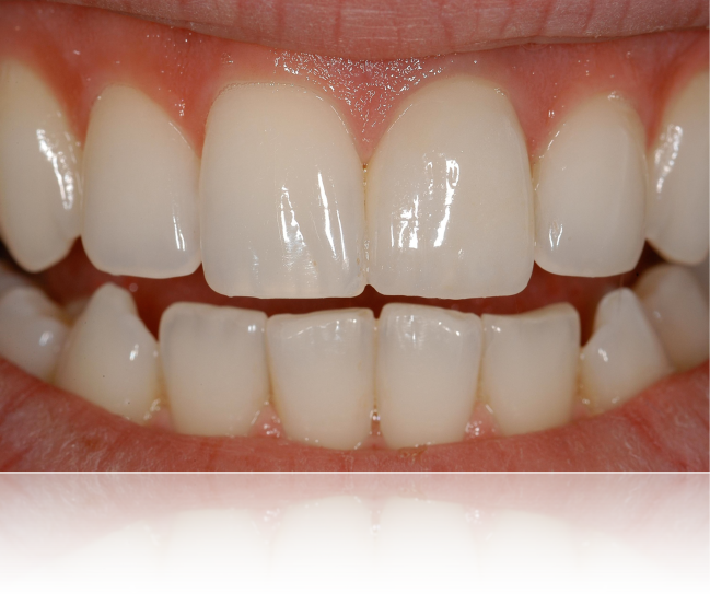 dent 21 en bouche passe inaperçu parmi les dents naturelles