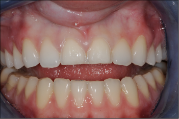 prépration du dentiste des dents 11 et 21 pour facettes de porcelaine feldspathique