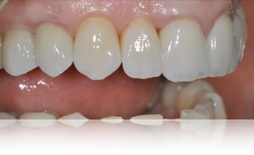 bouche d'un angle montrant les dents 15 à 21