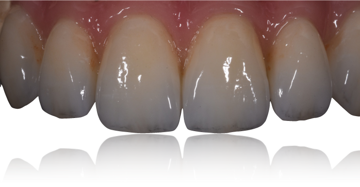 pont Zircone stratifiée sur implant avec gencive porcelaine translucide