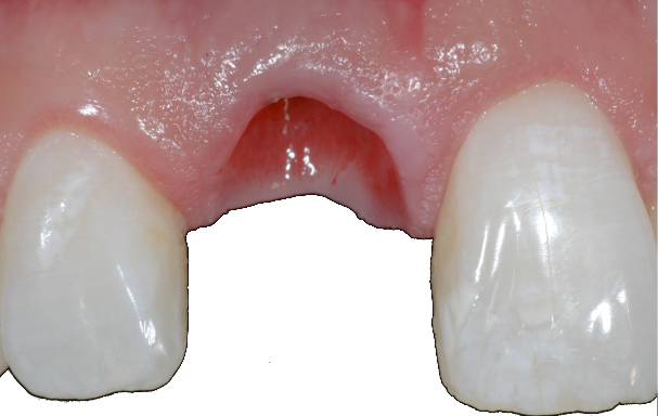 préparation du dentiste pour implant à la dent 11
