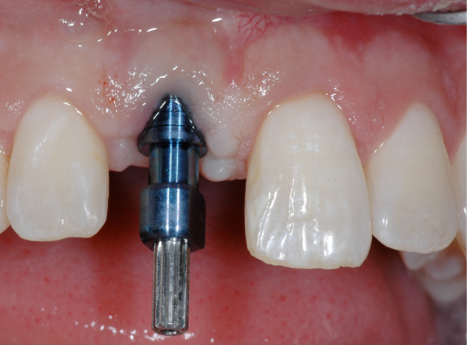 implant en bouche à la dent 11
