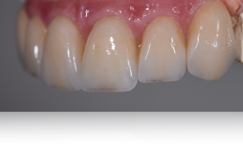 Pont Zircone sur implant avec gencive porcelaine