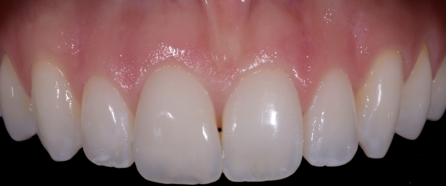 dents supérieures avec micro facette sur la dent 11