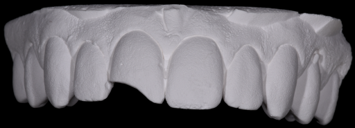 modèle réfractaire blanc des dents supérieures avec dent 11 brisée
